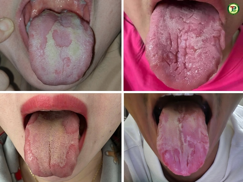 Biểu hiện nấm lưỡi ở người lớn