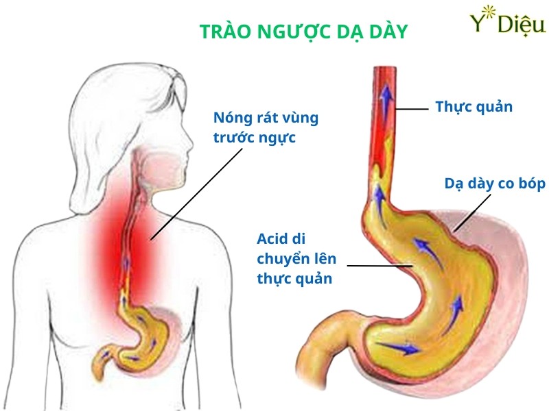 TRIỆU CHỨNG TRÀO NGƯỢC DẠ DÀY VÀ PHƯƠNG PHÁP ĐIỀU TRỊ