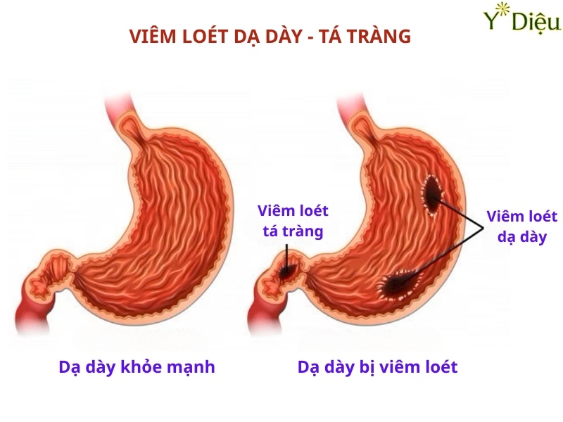 Vi khuẩn HP có thể gây ra viêm loét dạ dạy tá tràng