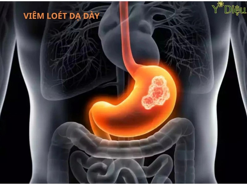 Đau dạ dày thường liên quan tới các tổn thương tại niên mạc dạ dày