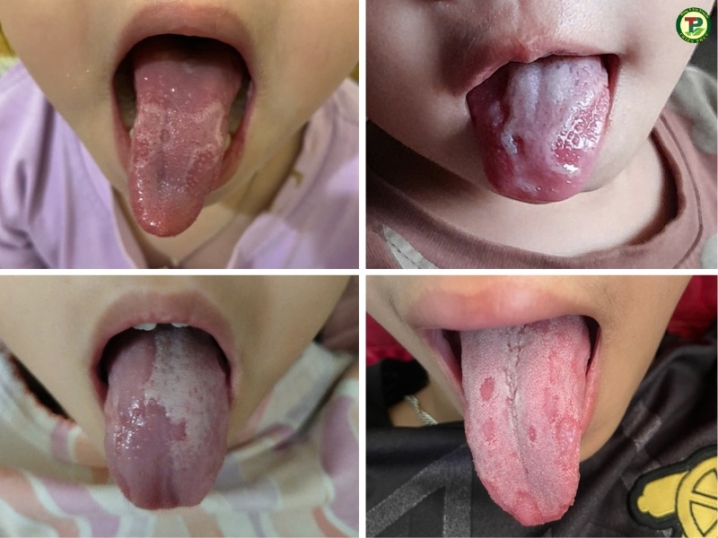 Biểu hiện nấm lưỡi ở trẻ em.