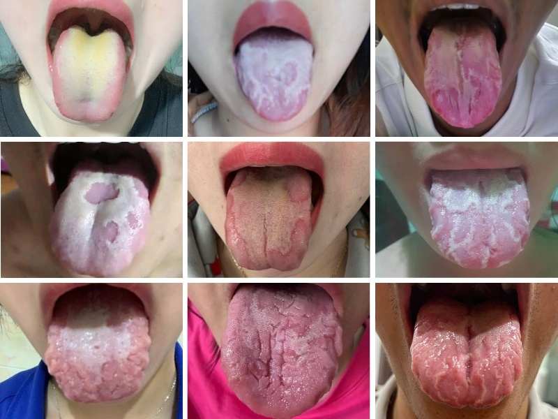 Nấm Lưỡi Ở Người Lớn: Nguyên Nhân Và Cách Điều Trị