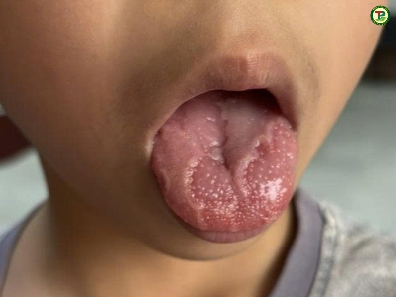 Khi bị nứt lưỡi nên vệ sinh cẩn thận hơn đặc bị với trẻ nhỏ