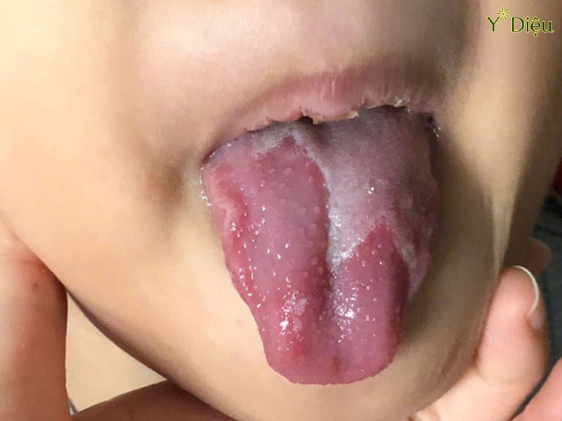 Nấm lưỡi bản đồ ở trẻ em
