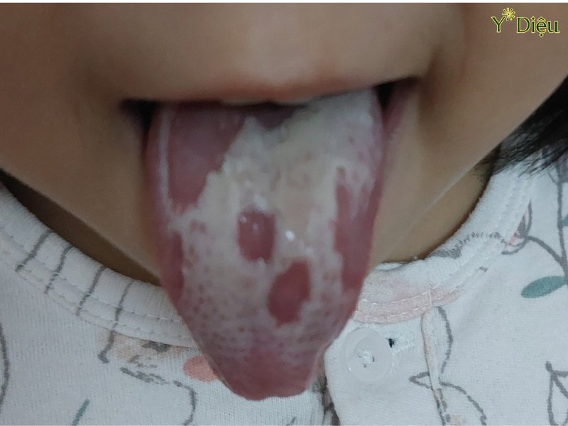 Lưỡi xuất hiện lớp trắng khó lau sạch