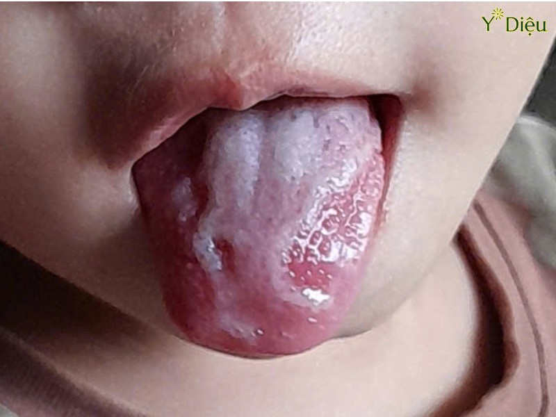 Bé Bị Lưỡi Bản Đồ: Nguyên Nhân và Cách Chăm Sóc Hiệu Quả