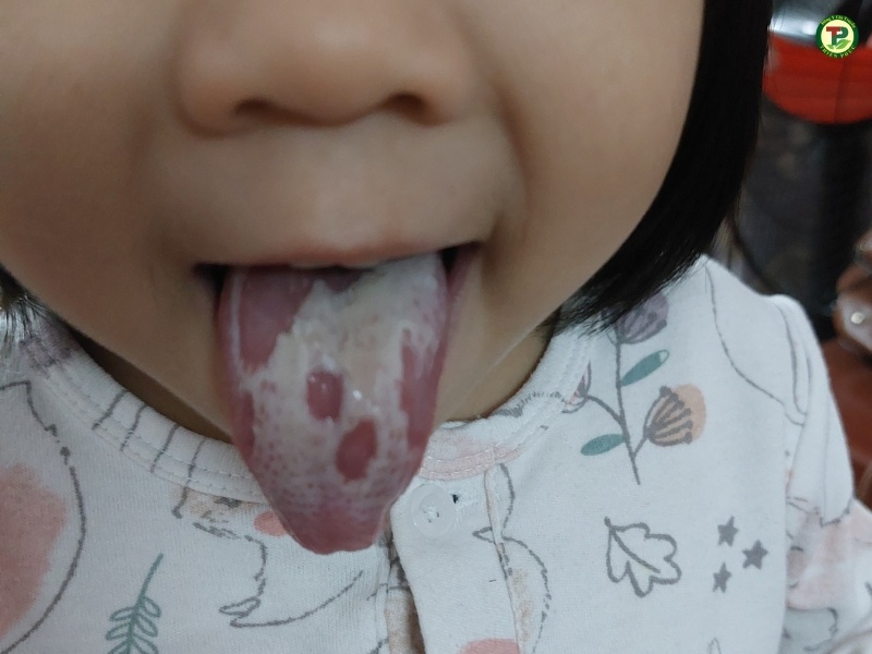 Có nhiều nấm lưỡi trắng trên bề mặt lưỡi gây mùi hôi và khó chịu.