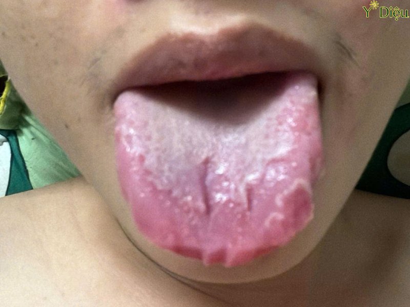 Viêm lưỡi bản đồ có dấu hiệu bị nứt