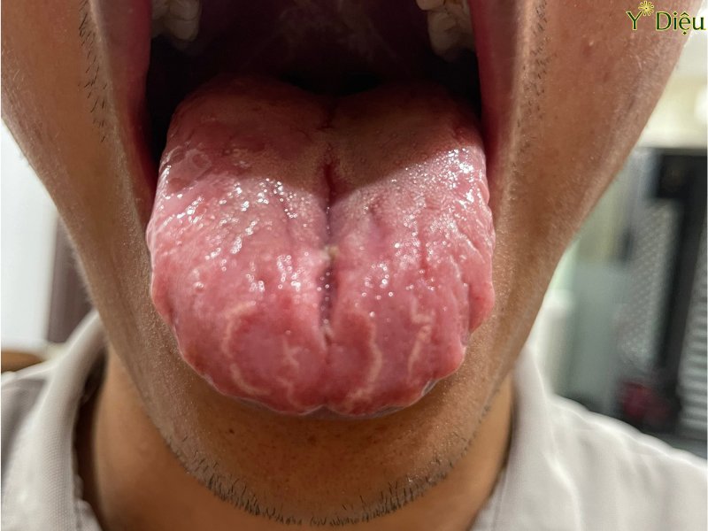 Bị vêm lưỡi bản đồ lâu dẫn tới nứt rảnh to ở giữa lưỡi