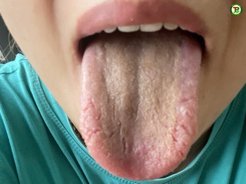 Nứt lưỡi nhẹ là khi lưỡi vừa chớm nứt và gây đau rát

