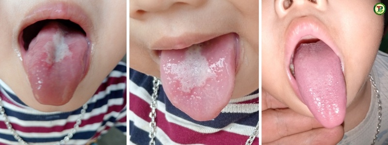 Lưỡi bé đã hồi phục hoàn toàn ăn uống cũng tốt hơn