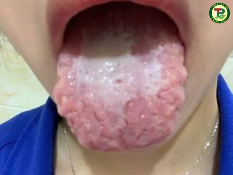 Viêm lưỡi bản đồ ở người lớn có thể gây nứt lưỡi