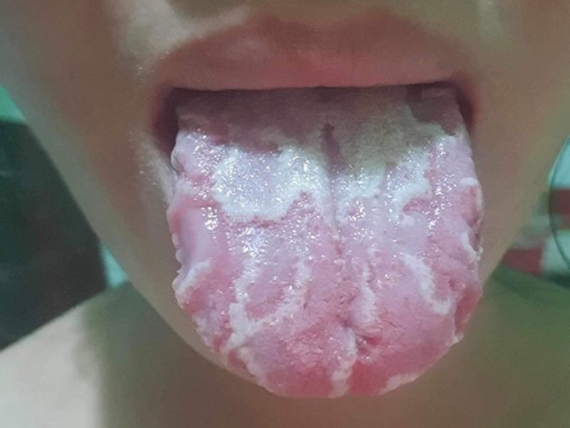 Viêm Lưỡi Bản Đồ Ở Người Lớn: Nguyên Nhân Và Cách Điều Trị