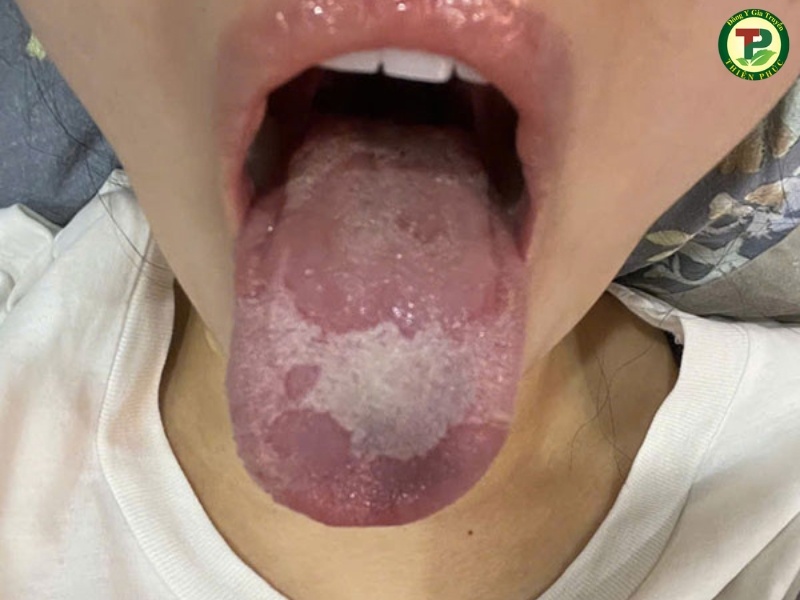 Lưỡi bị viêm xơ nhiều