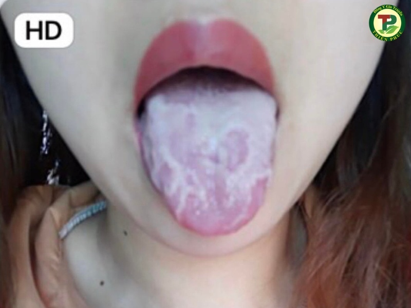 Hình ảnh viêm lưỡi bản đồ có nhiều nấm trắng

