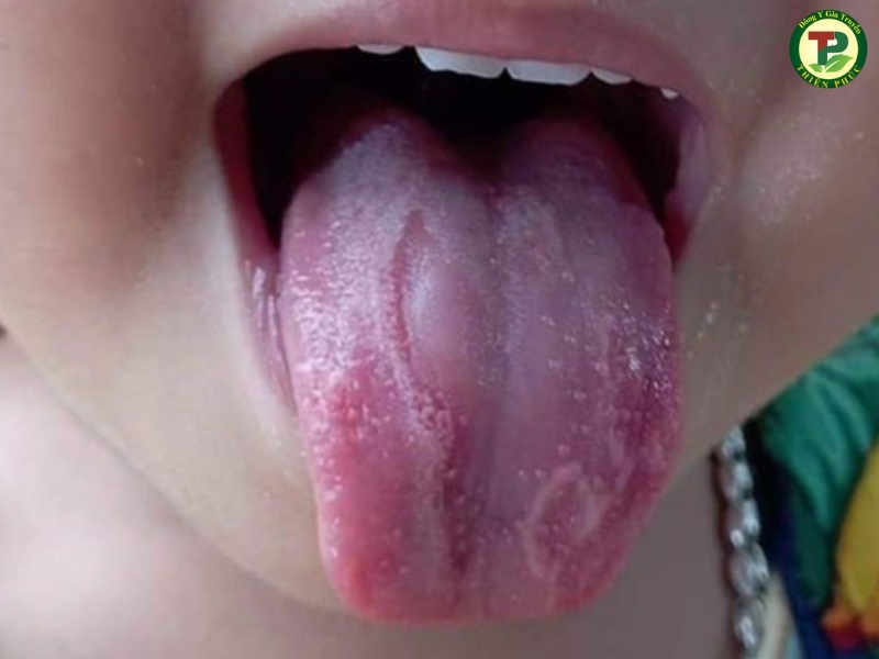 Viêm lưỡi bản đồ ở trẻ em có hình dạng không đều, giống như bản đồ địa lý.
