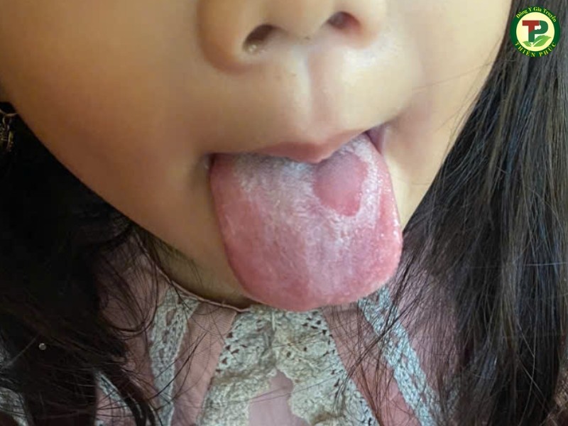 Nấm ăn gây ra viêm và xơ lưỡi