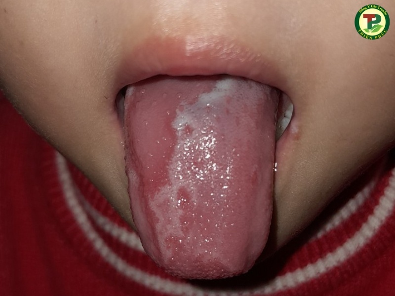Lưỡi bé bị nấm gây ra viêm lưỡi bản đồ