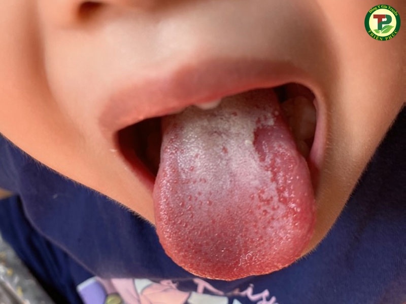 Bé bị viêm lưỡi do nấm candida