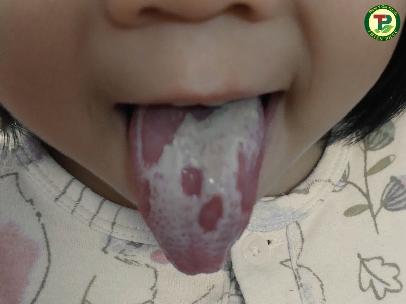 Lưỡi bị nhiều nấm trắng