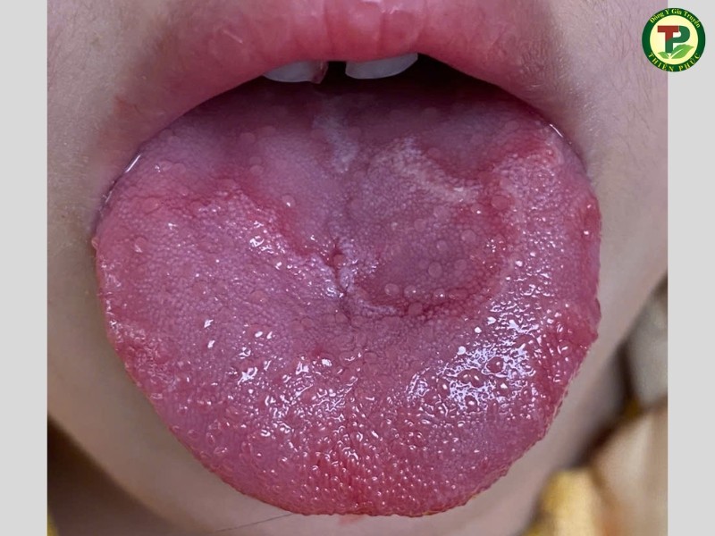 Hình ảnh viêm lưỡi bản đồ gây đau rát cho bé