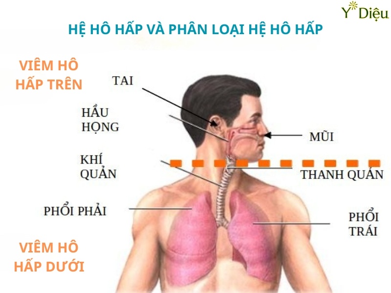 Ho cấp tính có thể do nhiễm trùng đường hô hấp trên.