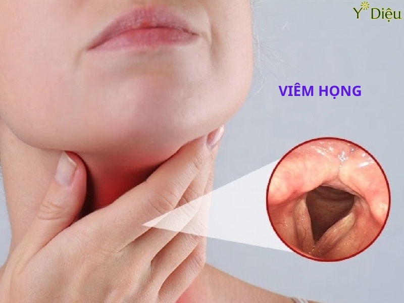 Có nhiều chủng virus gây cảm cúm, viêm họng