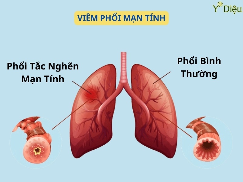 Viêm phổi mạn tính: Nguyên nhân, triệu chứng, cách điều trị