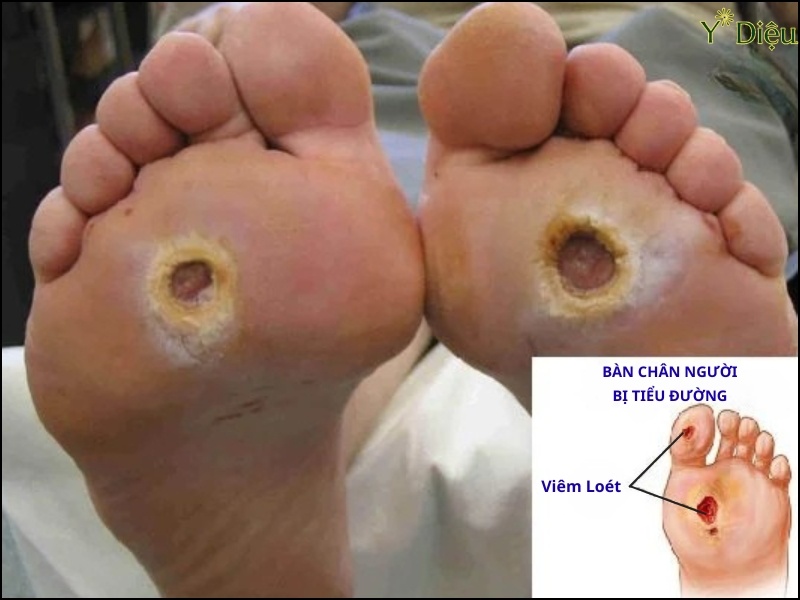 Biến chứng tiểu đường gây ra hoại tử ở lòng bàn chân.